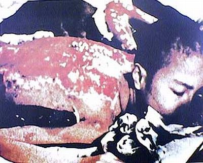Radiation Victim